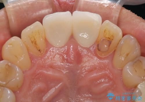 色のバランスの悪い前歯　オールセラミッククラウンで自然な口元にの治療後