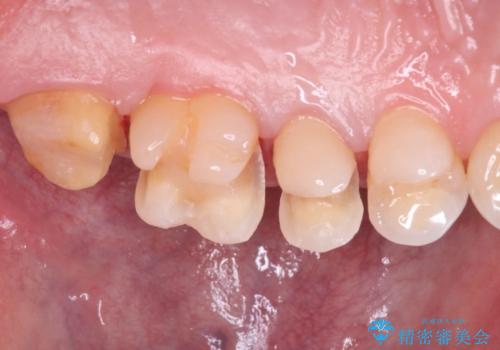 【メタルフリー】銀歯を綺麗な白い歯にの治療中