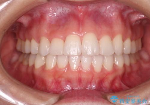 【審美装置】非抜歯矯正で八重歯改善!の症例 治療後