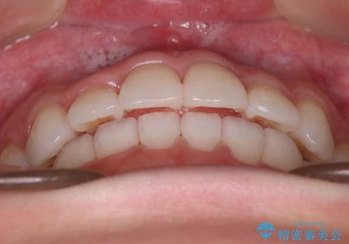 【審美装置】非抜歯矯正で八重歯改善!の治療後