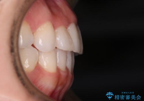 【審美装置】非抜歯矯正で八重歯改善!の治療後