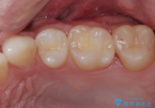 抜歯矯正で叢生と正中のずれを改善|審美装置による矯正症例の治療後