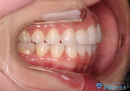 【審美装置】非抜歯矯正で八重歯改善!の治療後
