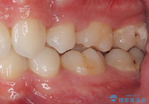 抜歯矯正で叢生と正中のずれを改善|審美装置による矯正症例の治療後