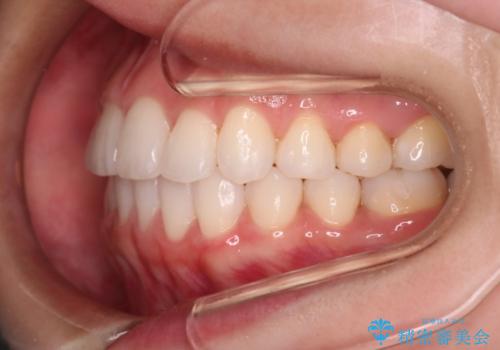 【審美装置】非抜歯矯正で八重歯改善!の治療後