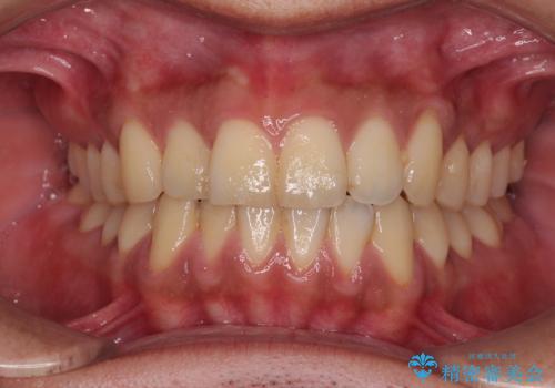 矯正後の後戻りをインビザラインライトで再治療|目立たない矯正の症例紹介の症例 治療前