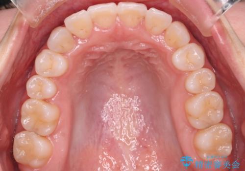 【審美装置】非抜歯矯正で八重歯改善!の治療後