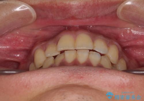 矯正後の後戻りをインビザラインライトで再治療|目立たない矯正の症例紹介の治療前