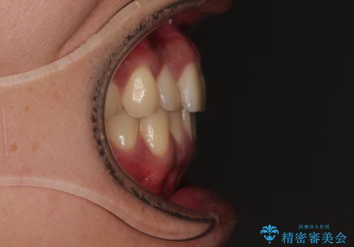 矯正後の後戻りをインビザラインライトで再治療|目立たない矯正の症例紹介の治療前