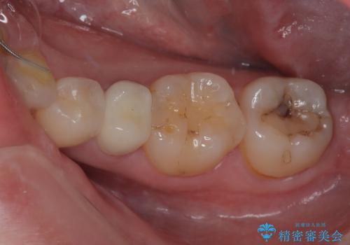 被せものが割れた　オールセラミッククラウン・セラミックインレー修復の症例 治療後