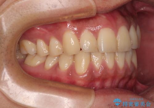 矯正後の後戻りをインビザラインライトで再治療|目立たない矯正の症例紹介の治療前