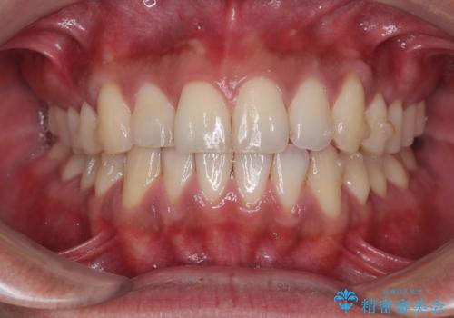 矯正後の後戻りをインビザラインライトで再治療|目立たない矯正の症例紹介の治療中