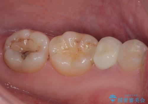 被せものが割れた　オールセラミッククラウン・セラミックインレー修復の治療後