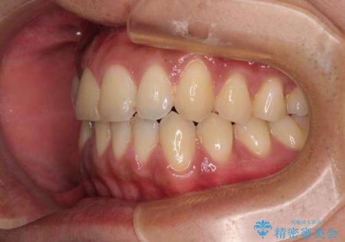 矯正後の後戻りをインビザラインライトで再治療|目立たない矯正の症例紹介の治療前