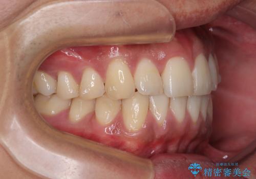 矯正後の後戻りをインビザラインライトで再治療|目立たない矯正の症例紹介の治療中