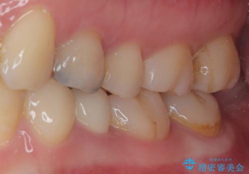 被せものが割れた オールセラミッククラウン・セラミックインレー修復の治療後