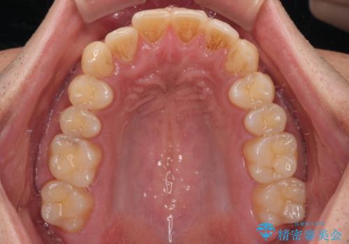 矯正後の後戻りをインビザラインライトで再治療|目立たない矯正の症例紹介の治療前