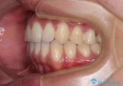 矯正後の後戻りをインビザラインライトで再治療|目立たない矯正の症例紹介の治療中