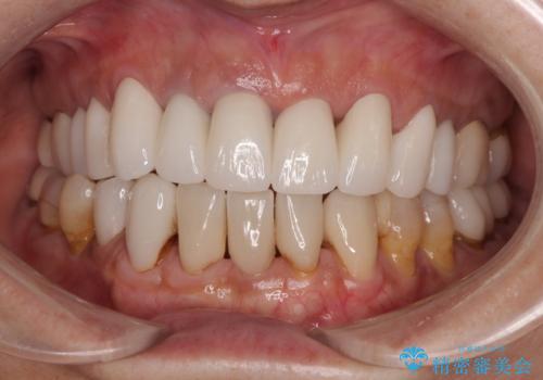 不釣り合いで境目の露出した前歯 オールセラミッククラウンによる審美歯科治療の治療後
