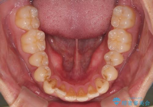 矯正後の後戻りをインビザラインライトで再治療|目立たない矯正の症例紹介の治療前