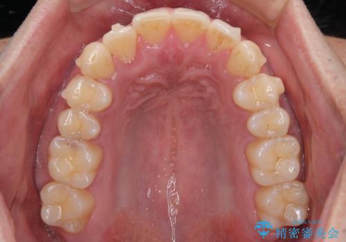 矯正後の後戻りをインビザラインライトで再治療|目立たない矯正の症例紹介の治療中