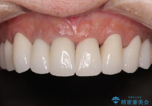 不釣り合いで境目の露出した前歯　オールセラミッククラウンによる審美歯科治療の治療後