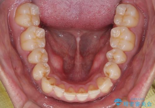 矯正後の後戻りをインビザラインライトで再治療|目立たない矯正の症例紹介の治療中