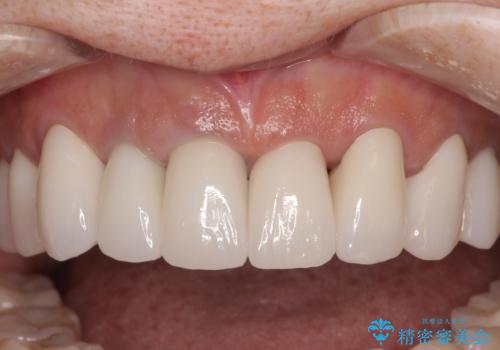 不釣り合いで境目の露出した前歯　オールセラミッククラウンによる審美歯科治療