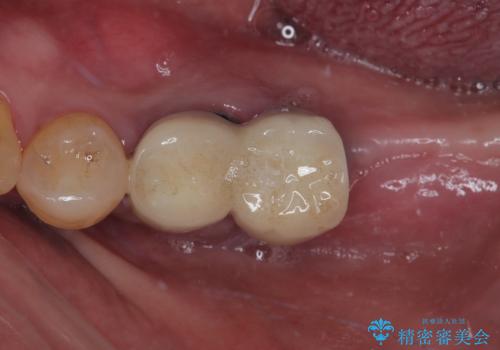 割れて揺れている奥歯 抜歯即時・早期埋入インプラント治療の治療前