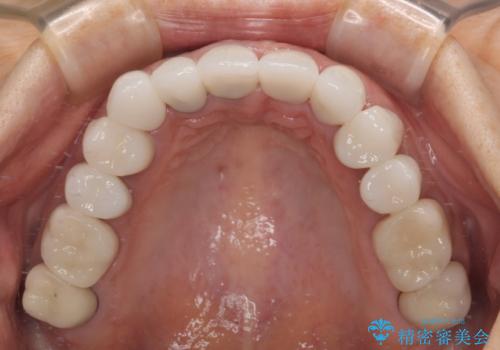 不釣り合いで境目の露出した前歯 オールセラミッククラウンによる審美歯科治療の治療後