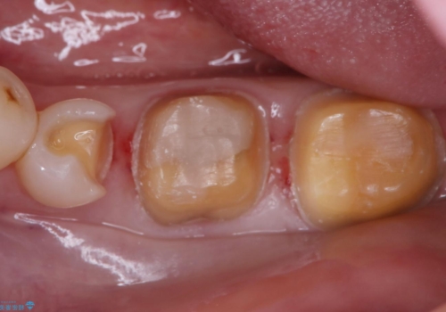 話すときに銀歯が見えて気になる セラミックでキレイに治す!の治療中