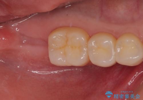 抜歯になった奥歯 速やかな埋入による短期間インプラント治療の治療前