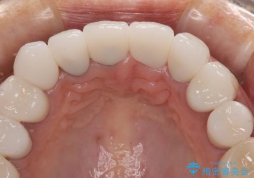 不釣り合いで境目の露出した前歯　オールセラミッククラウンによる審美歯科治療の治療後