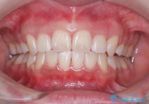 矯正後のホワイトニング希望の治療後