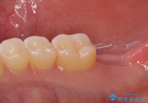 抜歯になった奥歯　速やかな埋入による短期間インプラント治療の治療前