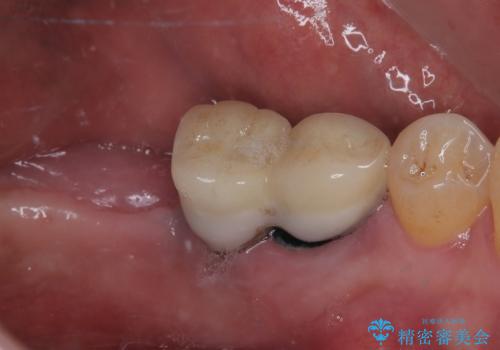 割れて揺れている奥歯 抜歯即時・早期埋入インプラント治療の治療前