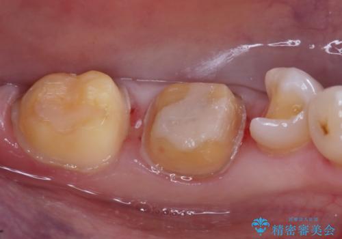 話すときに銀歯が見えて気になる　セラミックでキレイに治す!の治療中