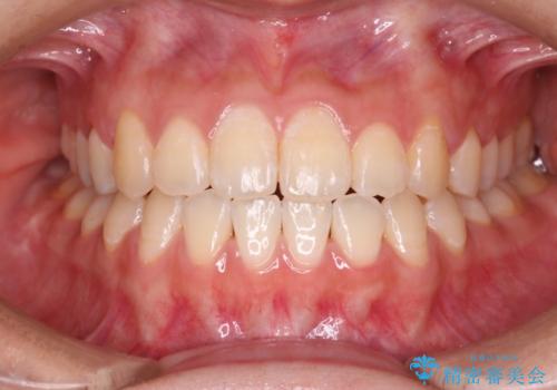 【審美ワイヤー】八重歯とがたつき気になるの症例 治療後