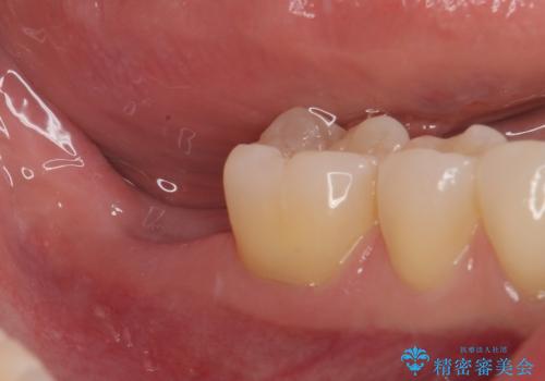 抜歯になった奥歯 速やかな埋入による短期間インプラント治療の治療前