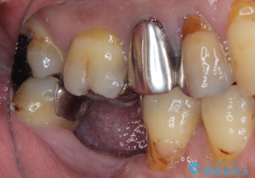 抜歯して放置したままの奥歯　即時荷重インプラントの治療前