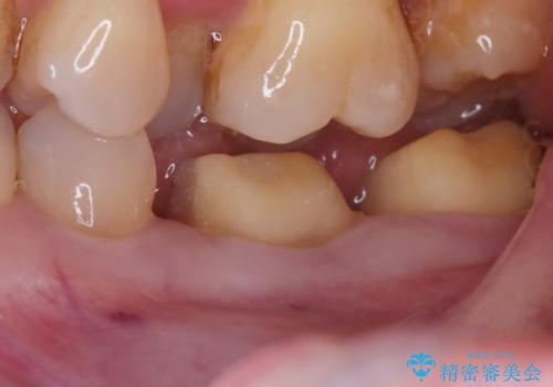 話すときに銀歯が見えて気になる セラミックでキレイに治す!の治療中