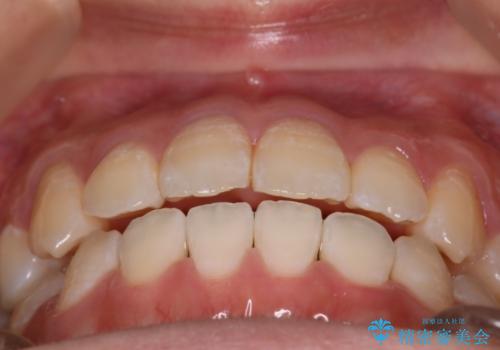 【審美ワイヤー】八重歯とがたつき気になるの治療後