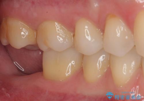 抜歯になった奥歯　速やかな埋入による短期間インプラント治療の治療前