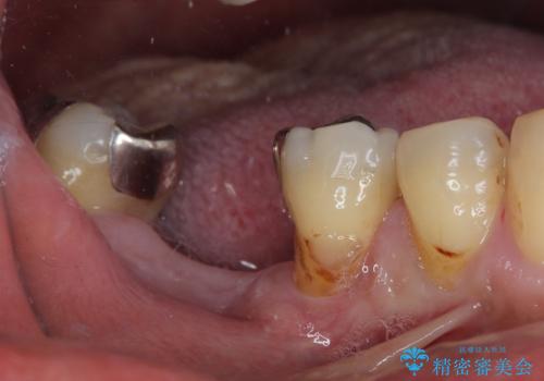 抜歯して放置したままの奥歯　即時荷重インプラントの治療前