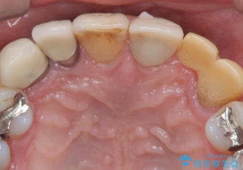 【セラミッククラウン】【エクストリュージョン】抜歯はしたくないの治療前