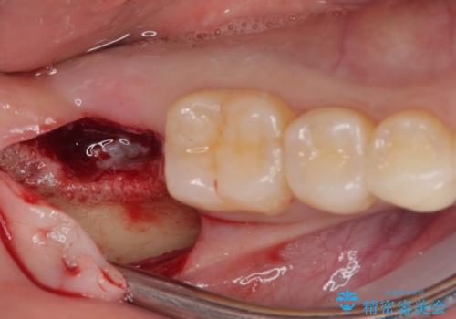 抜歯になった奥歯　速やかな埋入による短期間インプラント治療の治療中