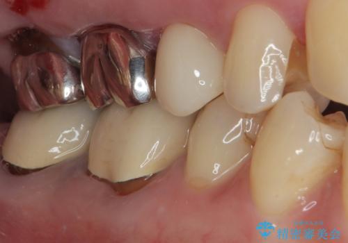 欠けた詰め物を精密セラミックインレーで自然に修復した症例の治療前