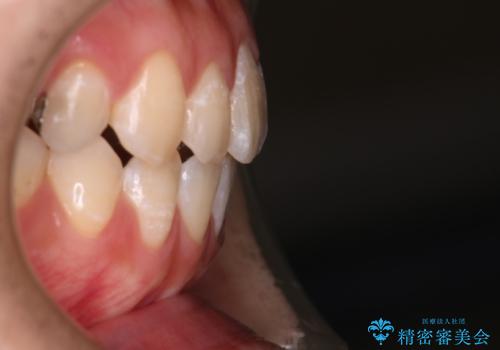 【審美ワイヤー】八重歯とがたつき気になるの治療後