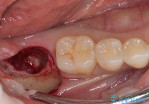 抜歯になった奥歯　速やかな埋入による短期間インプラント治療の治療後