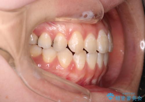 【審美ワイヤー】八重歯とがたつき気になるの治療後